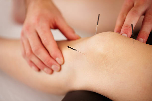 View of woman's leg with acupuncture needles - Blueridge Physio